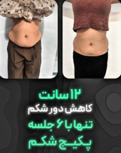 نمونه لاغری موضعی دکتر محمدامین صنعتی