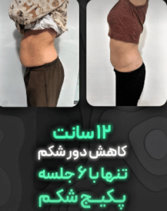 نمونه لاغری موضعی دکتر محمدامین صنعتی