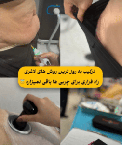 نمونه لاغری موضعی دکتر محمدامین صنعتی