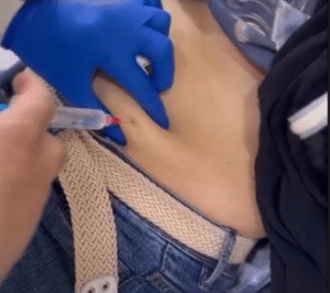 نمونه لاغری موضعی دکتر محمدامین صنعتی