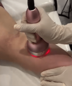 نمونه لاغری موضعی دکتر سید محمد رضا قریشی