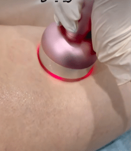 نمونه لاغری موضعی دکتر سید محمد رضا قریشی