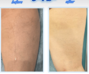 نمونه لاغری موضعی دکتر سید محمد رضا قریشی