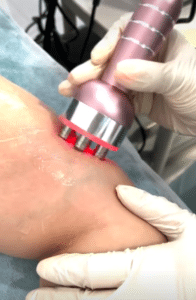 نمونه لاغری موضعی دکتر سید محمد رضا قریشی