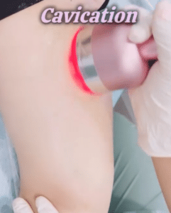 نمونه لاغری موضعی دکتر سید محمد رضا قریشی