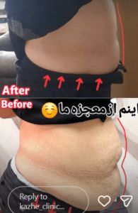 نمونه لاغری موضعی کلینیک زیبایی کاژه