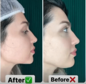 نمونه لاغری موضعی کلینیک زیبایی کاژه