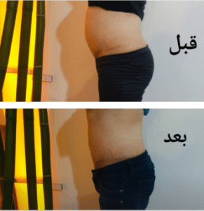 نمونه لاغری موضعی کلینیک زیبایی دانژه
