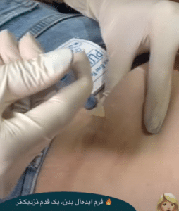 نمونه لاغری موضعی کلینیک زیبایی دانژه