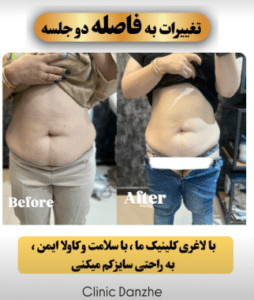 نمونه لاغری موضعی کلینیک زیبایی دانژه