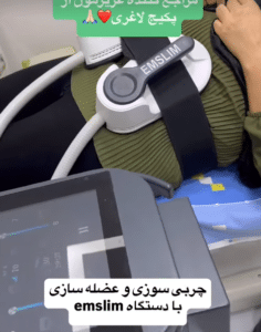 نمونه لاغری موضعی دکتر علی خوش نظر