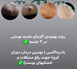 نمونه درمان های پوستی دکتر سارا احتشامی