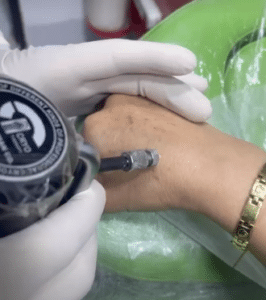 نمونه درمان لک پوستی دکتر علی خوش نظر