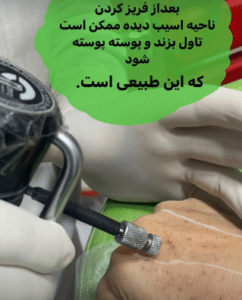 نمونه درمان لک پوستی دکتر علی خوش نظر