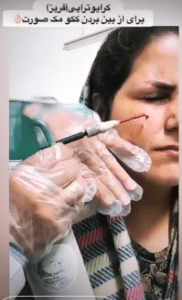 نمونه درمان لک پوستی دکتر علی خوش نظر