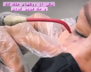 نمونه درمان لک پوستی دکتر علی خوش نظر