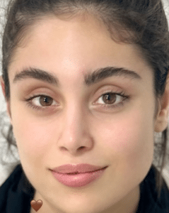 نمونه درمان مشکلات پوستی دکتر گالیا رنجبری