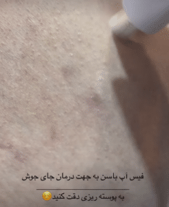 نمونه درمان مشکلات پوستی دکتر زهره حاج حیدری
