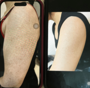 نمونه درمان مشکلات پوستی دکتر زهره حاج حیدری