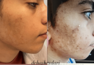 نمونه درمان مشکلات پوستی دکتر زهره حاج حیدری