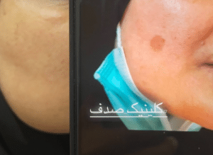 نمونه درمان مشکلات پوستی دکتر زهره حاج حیدری