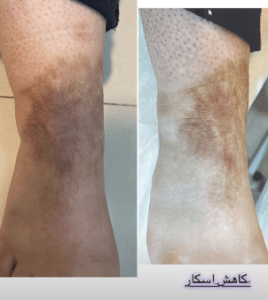 نمونه درمان مشکلات پوستی دکتر زهره حاج حیدری