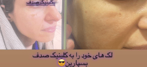 نمونه درمان مشکلات پوستی دکتر زهره حاج حیدری