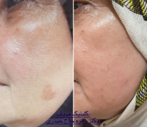 نمونه درمان مشکلات پوستی دکتر زهره حاج حیدری
