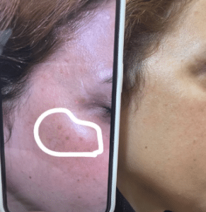 نمونه درمان مشکلات پوستی دکتر زهره حاج حیدری