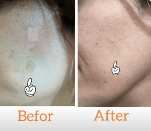 نمونه درمان مشکلات پوستی دکتر زهره حاج حیدری