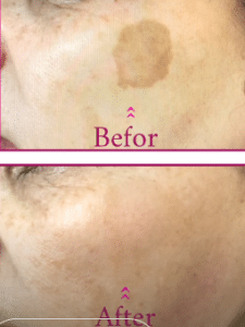 نمونه درمان مشکلات پوستی دکتر زهره حاج حیدری