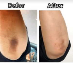 نمونه درمان مشکلات پوستی دکتر زهره حاج حیدری