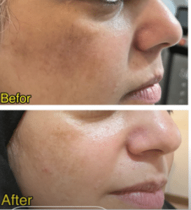 نمونه درمان مشکلات پوستی دکتر زهره حاج حیدری