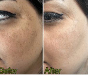 نمونه درمان مشکلات پوستی دکتر زهره حاج حیدری