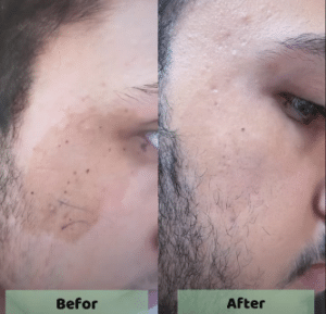 نمونه درمان مشکلات پوستی دکتر زهره حاج حیدری