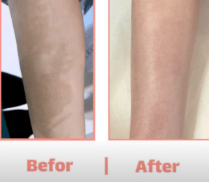 نمونه درمان مشکلات پوستی دکتر زهره حاج حیدری