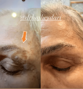 نمونه درمان مشکلات پوستی دکتر زهره حاج حیدری