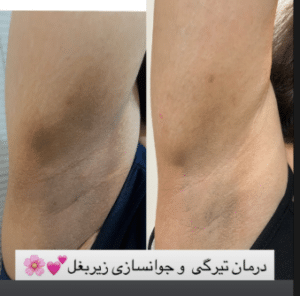 نمونه درمان مشکلات پوستی دکتر زهره حاج حیدری