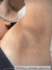 نمونه درمان مشکلات پوستی دکتر زهره حاج حیدری