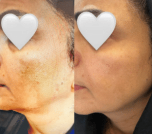 نمونه درمان مشکلات پوستی دکتر زهره حاج حیدری