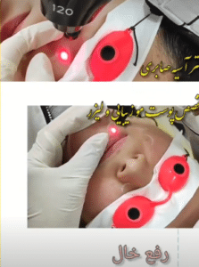 نمونه درمان بیماری های پوستی دکتر آسیه صابری