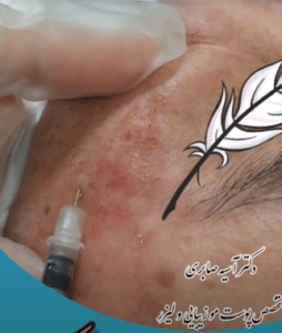 نمونه درمان بیماری های پوستی دکتر آسیه صابری