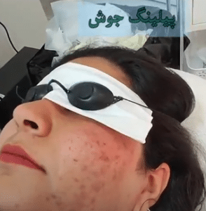 نمونه درمان بیماری های پوستی دکتر آسیه صابری