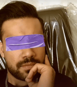 نمونه کاشت ابرو کلینیک پدیده