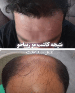 نمونه کاشت مو کلینیک پدیده