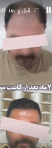 نمونه کاشت ابرو کلینیک پدیده