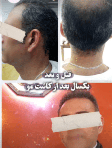 نمونه کاشت ابرو کلینیک پدیده