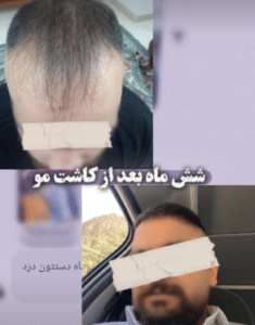 نمونه کاشت ابرو کلینیک پدیده