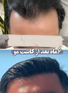 نمونه کاشت ابرو کلینیک پدیده
