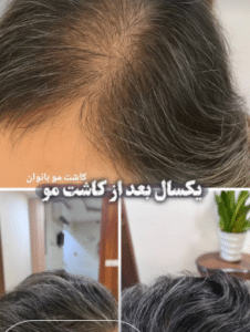 نمونه کاشت ابرو کلینیک پدیده